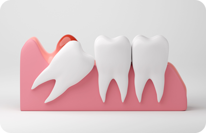 Wisdom tooth infection and inflammation gums on white background, 3D rendering.